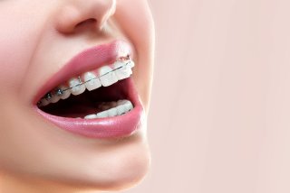 Dr. Bartels | Kieferorthopädie | Durchsichtige Kunststoff-Brackets