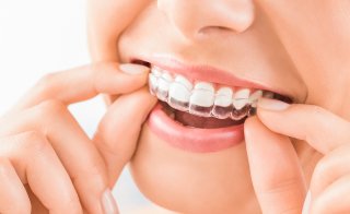 Dr. Bartels | Kieferorthopädie | Invisalign Technik